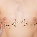 gynecomatia