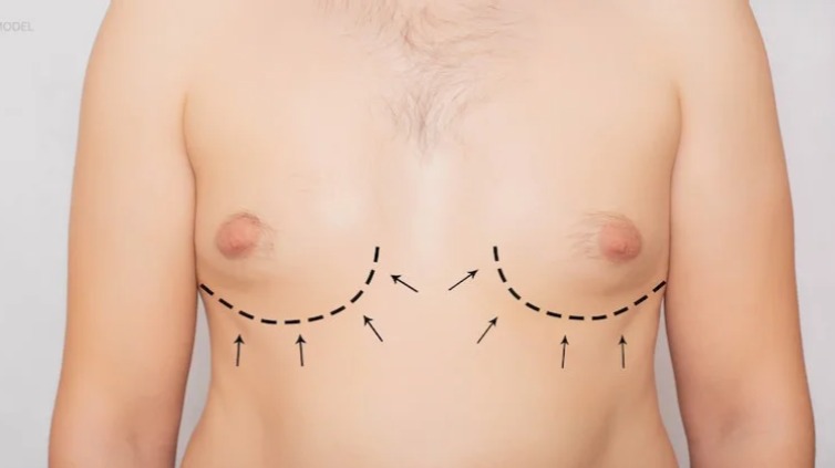 gynecomatia