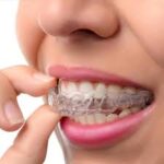 Invisalign Treatment