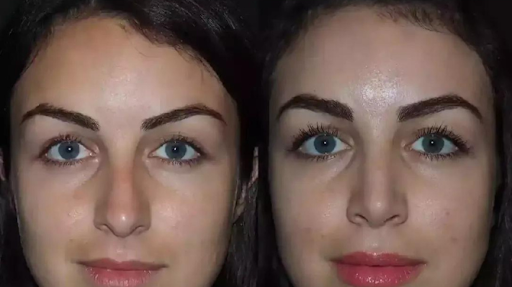rhinoplasy in dubai