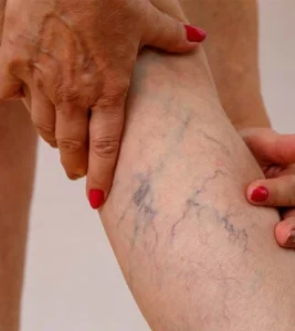 Deep Vein Thrombosis Treatment in Jaipur