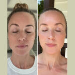 Fotona 4D Laser in Dubai