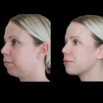 Jawline Fillers