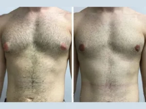 Revision Cases Handled by the Best Gynecomastia Surgeon in Dubai