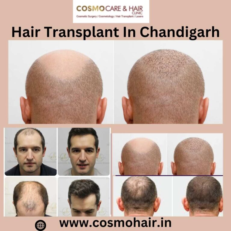 best hair transplant in Chandigarh
