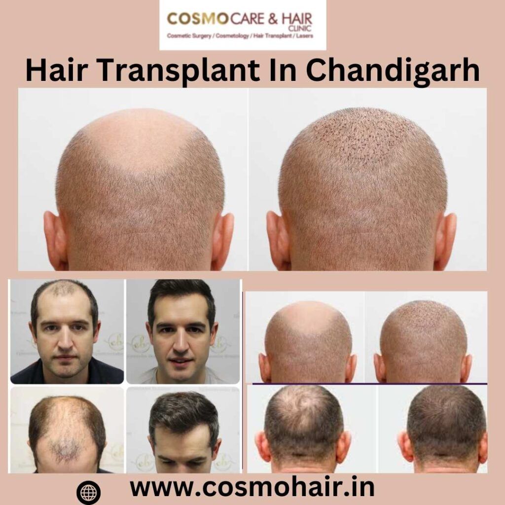 hair transplant in Chandigarh