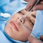 جراحة تجميل الأنف