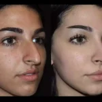 nose surgery in dubai