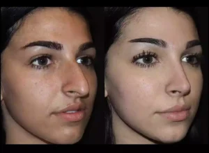 nose surgery in dubai