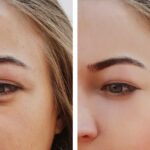 Under-Eye-Fat-Transfer