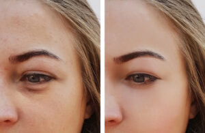 Under-Eye-Fat-Transfer