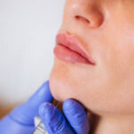Lip Filler Aberdeen