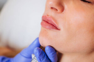 Lip Filler Aberdeen