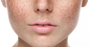 pigmentation-treatments