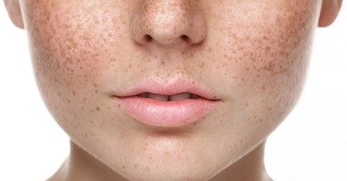 pigmentation-treatments