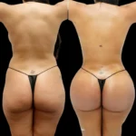 How Butt Fat Transfer Surgery in Dubai Enhances Natural Beauty