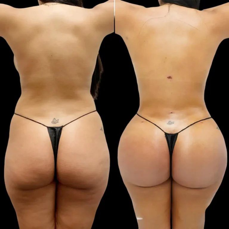 How Butt Fat Transfer Surgery in Dubai Enhances Natural Beauty