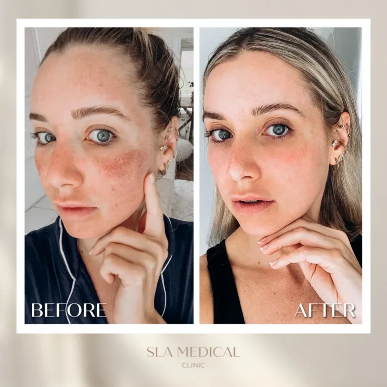 Co2 Laser In Manchester