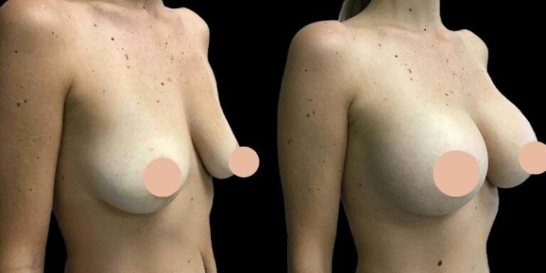 How the Best Doctors in Dubai Guide You Through Breast Augmentation Size Selection