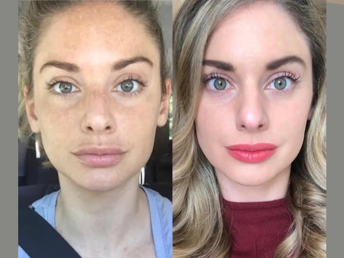 H11-RF-Microneedling