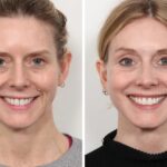 Best Doctors in Dubai Break Down Thread Lift Treatment Steps