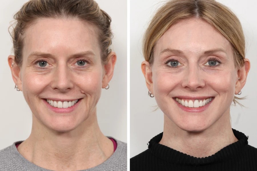 Best Doctors in Dubai Break Down Thread Lift Treatment Steps