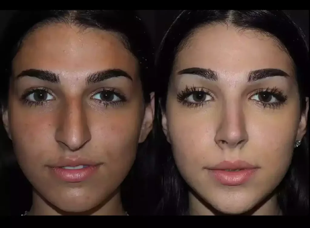rhinoplasty in dubai