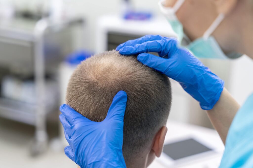 زراعة الشعر في الرياض