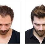 زراعة الشعر في الرياض