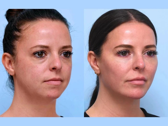 Best Aesthetic Clinic in Dubai: Thread Lift Technology Achieving Smoother Skin