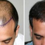 زراعة الشعر في الرياض