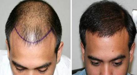 زراعة الشعر في الرياض