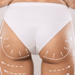 Butt Fat Transfer in Dubai