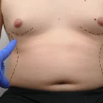 TUMMY-TUCK-ABDOMINOPLASTY