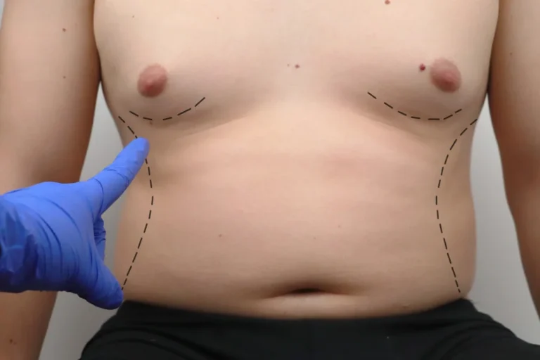TUMMY-TUCK-ABDOMINOPLASTY