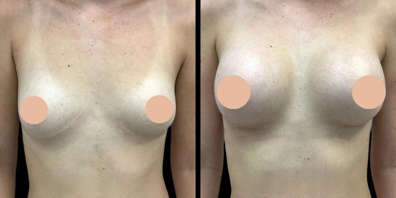 Breast Enlargement in dubai