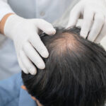 Alopecia Treatment in Islamabad