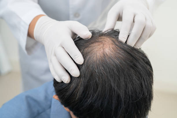 Alopecia Treatment in Islamabad