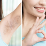 Armpit Hair Removal in Islamabad