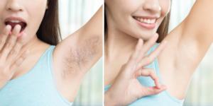Armpit Hair Removal in Islamabad
