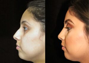 Rhinoplasty in Riyadh
