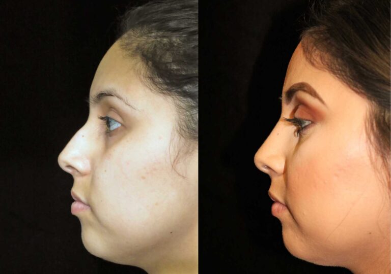 Rhinoplasty in Riyadh