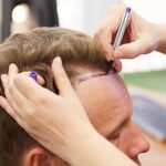 DHI Hair Transplant in Islamabad