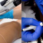 Electrolysis Hair Removal in Islamabad