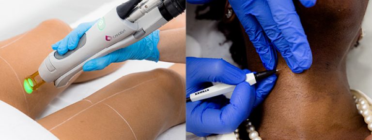 Electrolysis Hair Removal in Islamabad