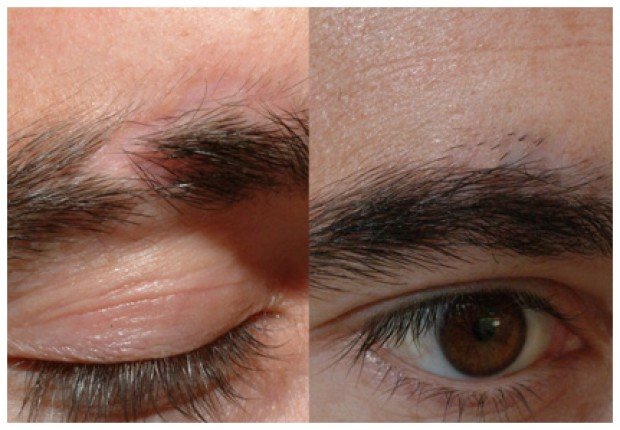 Eyebrow Hair Transplant in Islamabad