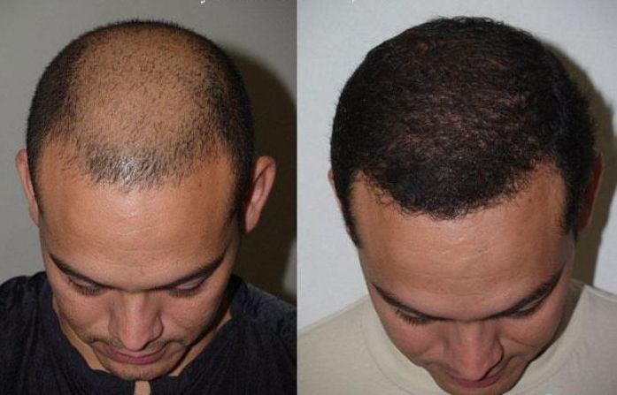 FUE Hair Transplant in Islamabad