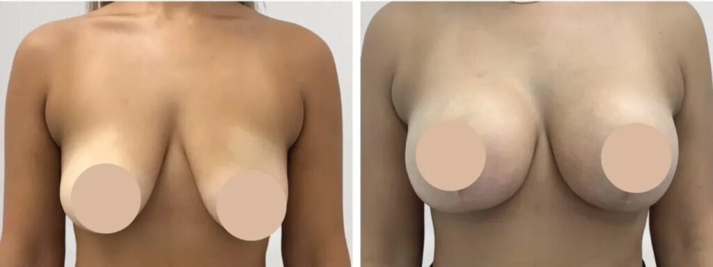 H1-Breast-reduction