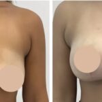 H1-Breast-reduction