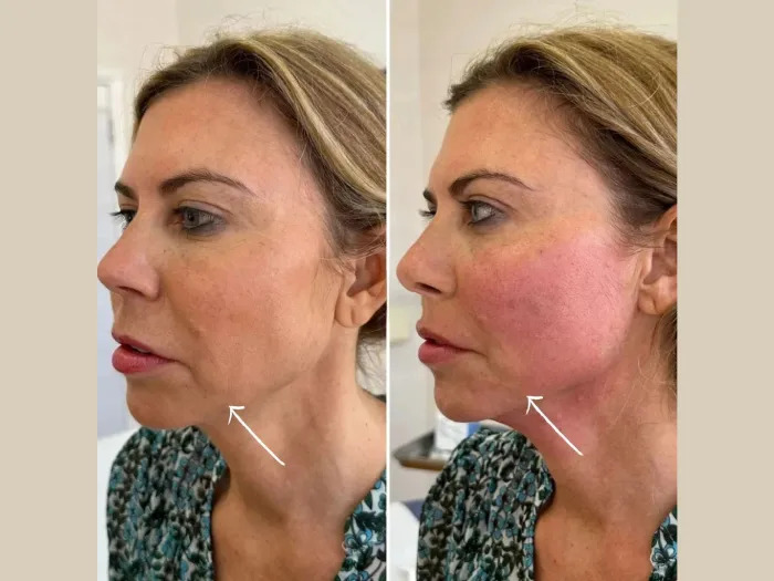 Endolift for Jawline Definition by the Best Plastic Surgeon in dubai